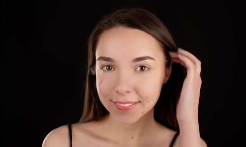 Remove Pimples Naturally and Permanently