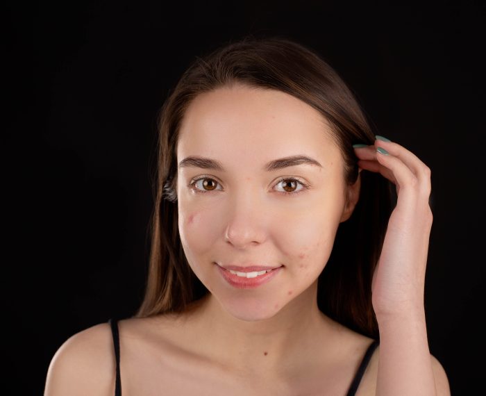 Remove Pimples Naturally and Permanently